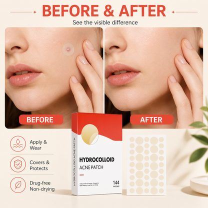 Clear Blemish Patches - 144 Pack